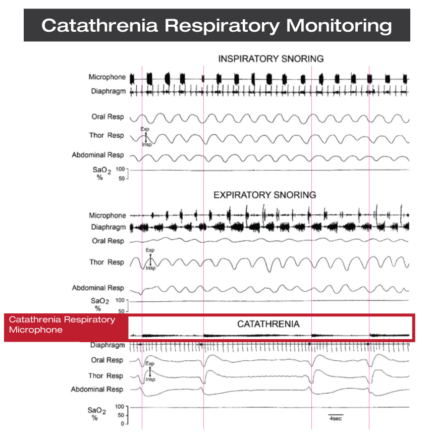 CatathreniaRespiratoryMonitoring