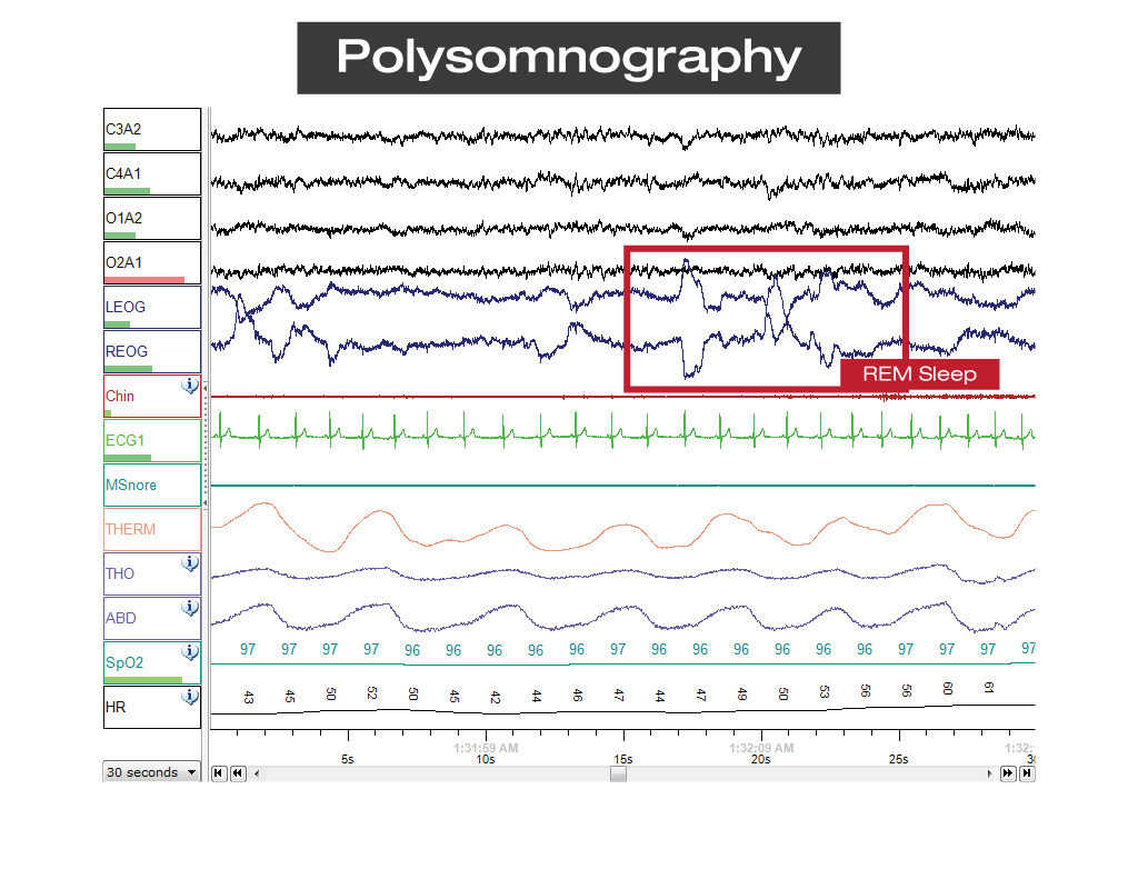 PolysomnographyREMSleep