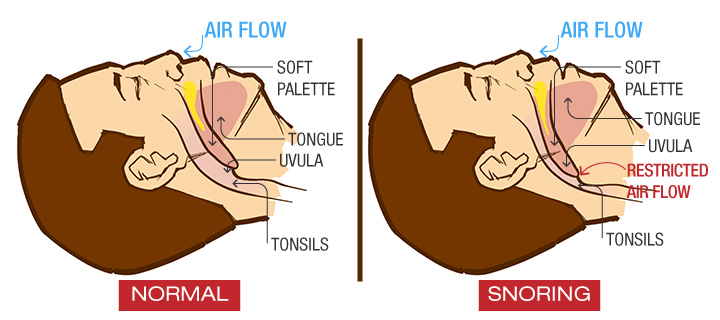 CauseOfSnoring